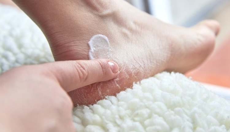 بررسی علت ترک پا و نحوه درمان آن با بهترین کرمها 1 cracked heels